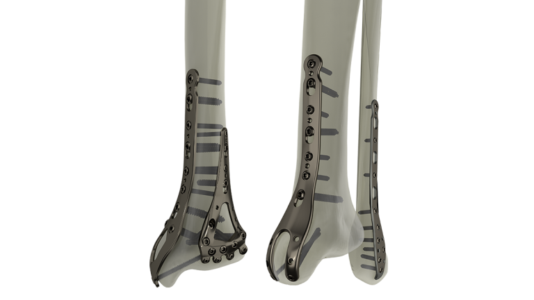 Product-_STEP_Ankle_Plating_System