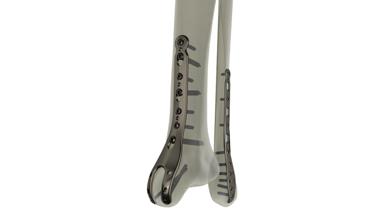 Product-_STEP_Ankle_Plating_System_1